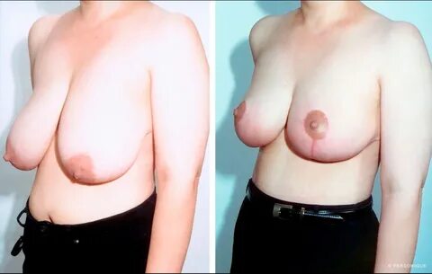 Breast Reduction Before and After Gallery