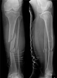Icd 10 Code For Fracture Tibia Therapy - Fracture