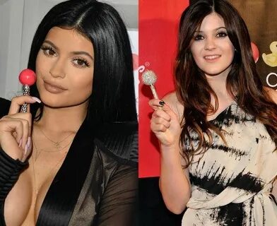 Kylie Jenner Plastic Surgery - Docs Say Stop Now Before It’s