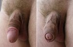 File:Penis glans and foreskin.jpg - Wikipedia