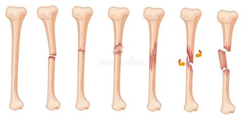 Leg Bones Diagram / Leg bone - Wikipedia / The femur in the 