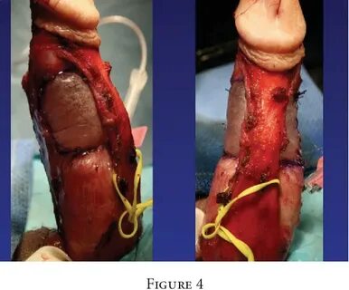Figure 4 from Peyronie's Disease: Still a Surgical Disease S
