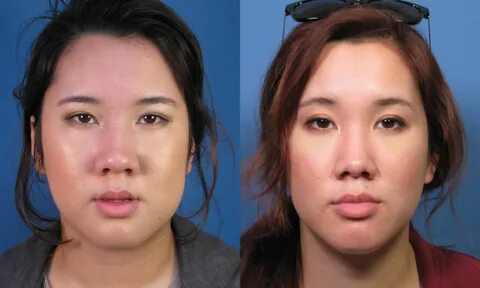 Asian Rhinoplasty Nose Job Surgery by Expert Ethnic Nose Sur