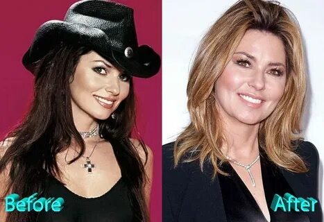 Shania Twain Plastic Surgery: A New Look For A New Start Pla