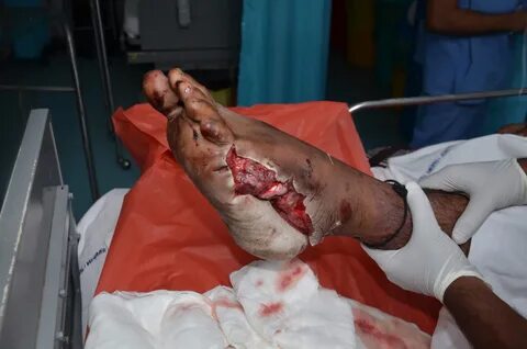 CIRCUMFERENTIAL DEGLOVING OF THE FOOT WITH LIS FRANC JOINT D