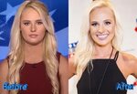 Tomi Lahren Plastic Surgery: Making Headlines For Her Face
