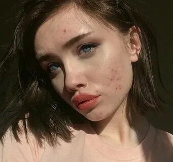 𝓜 𝓘 𝓘 𝓡 𝓘 𝓐 𝓐 " Girl with acne, Pretty face, Beauty