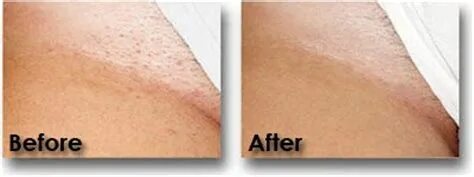 Pubic Hair Removal Before And After Pictures : Pin on Beauty