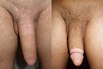 File:Adult circumcision before and after (2).jpg - Wikipedia