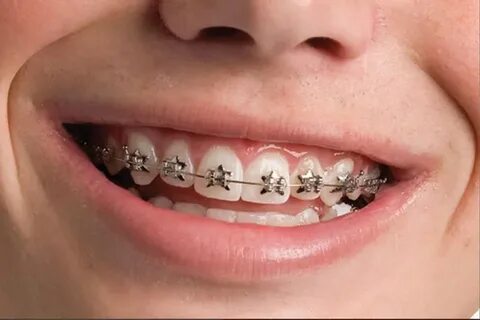Pin on Braces and Retainers-Orthodontics