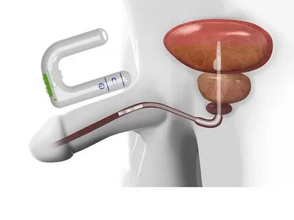 Wireless Smart Catheter For Bladder Control: Interview With 