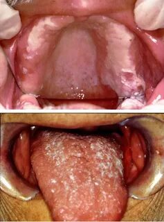 Image: Thrush (Under Dentures and on Tongue) - Merck Manuals