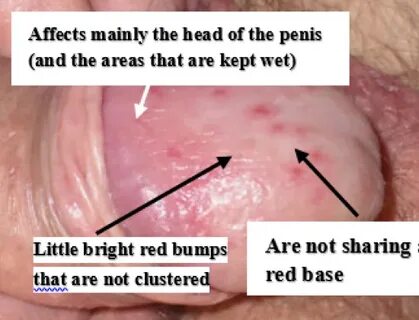 Red dots on penis 🔥 red dots on penis after masturbation