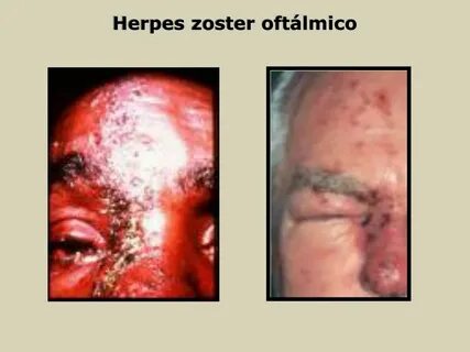 PPT - Herpes Zoster PowerPoint Presentation, free download -