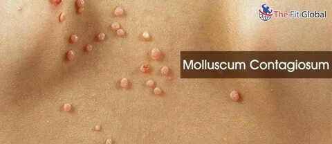 15 Best Remedies - Molluscum Contagiosum Natural Treatment