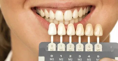 How much do veneers cost you?