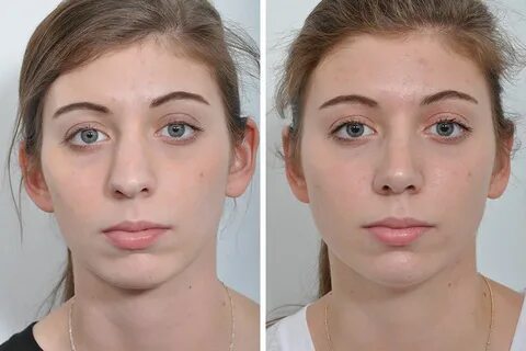 Learn The Trending Techniques About Secured Nose Job Boston 