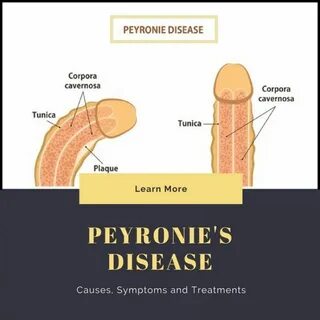 Peyronie's Disease: Causes, Symptoms And Treatment