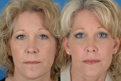 Facelift Before & After Photos Benjamin Bassichis MD, FACS