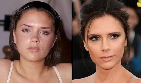 Victoria Beckham before and after plastic surgery Victoria b