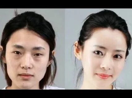 Korean Plastic Surgery Before And After Photos Korean plasti