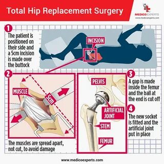 MedicoExperts в Твиттере: "Total Hip replacement surgery For