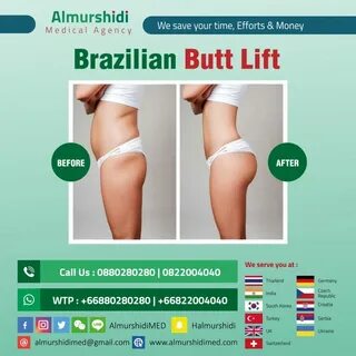 Fat transfer to Butt (Brazilian Butt Lift) in Bangkok, Thail