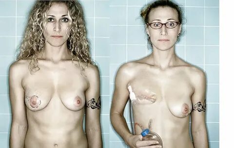 Mastectomy - 49 Pics xHamster