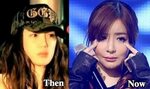 Park Bom Plastic Surgery Before and After Photos