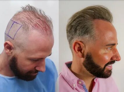 Hair transplant - este care clinic