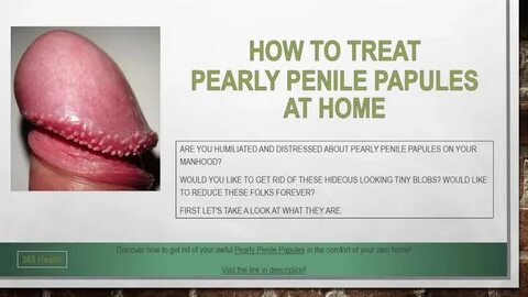 Pin on How To Get Rid Of Pearly Penile Papules In 3 days