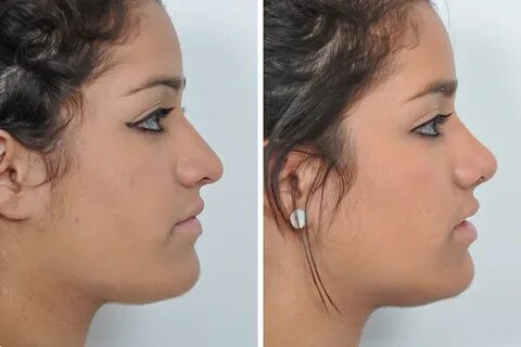 Rhinoplasty-44