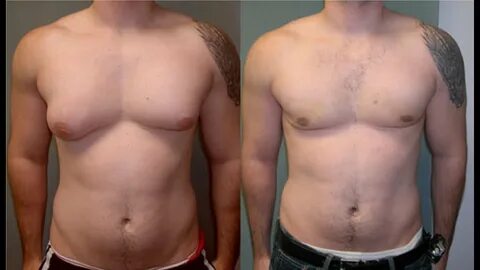 gynecomastia, how to get rid of gynecomastia, what is gyno, causes of gynec...