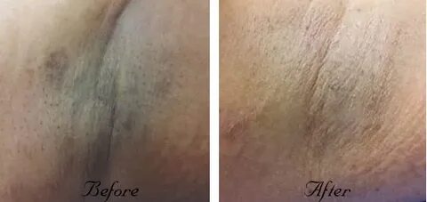 Vaginal bleaching before and after - Selected porn videos wi