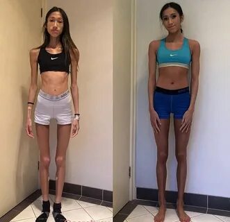 Medical student suffering anorexia nervosa exercises 3 hours