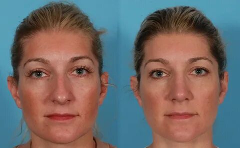 Rhinoplasty before and after patient photos