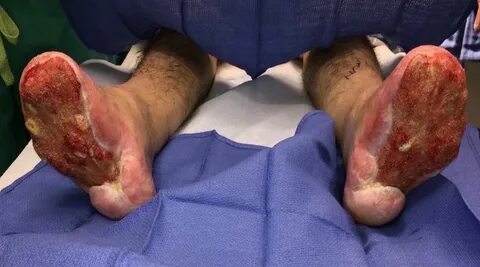 Symmetrical peripheral gangrene of bilateral feet and unilat