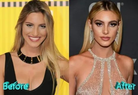 Lele Pons Before and After Nose Job Lele pons nose job, Big 