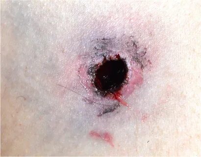 Pathology Outlines - Gunshot wounds