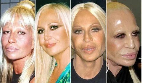 Donatella Versace Bad Plastic Surgery Celebrity Bad Plastics