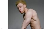 Этого парня-альбиноса травили в школе