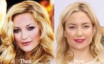 kate-hudson-nose-job - Latest Plastic Surgery Gossip And New