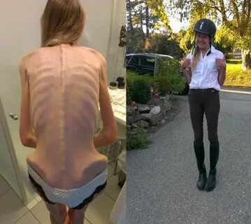 Anorexic Girl Inspires People To Get Healthy After Being Day