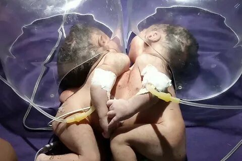 Conjoined twin girls born sharing same heart