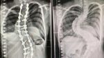 Twists and turns of scoliosis surgery for Hamilton woman Stu
