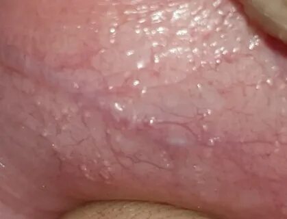 Are these fordyce spots Penis Disorders Forums Patient
