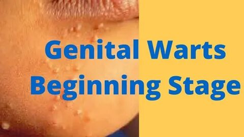 Genital Warts.