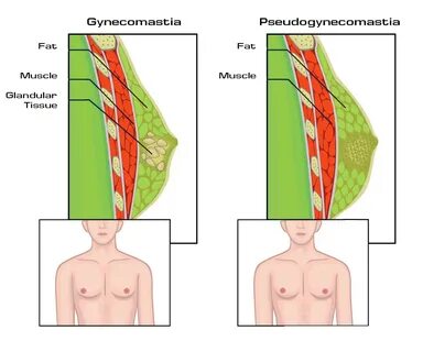 Lose Man Boobs - How To Treat Gynecomastia Without Surgery. 