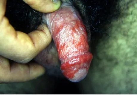 Yeast infection too much sex Top Porn Photos