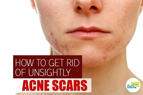 How To Get Rid Of Neck Acne Scars - Enter-norton